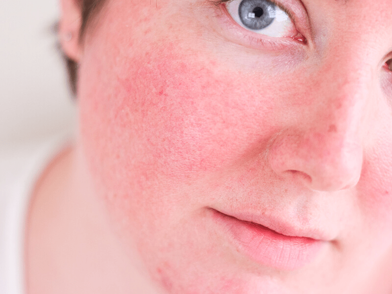 Dicas para peles com rosácea!. Entenda tudo sobre sua pele